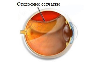 Отслойка сетчатки