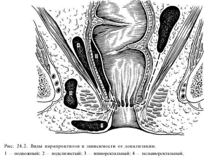 Парапроктит