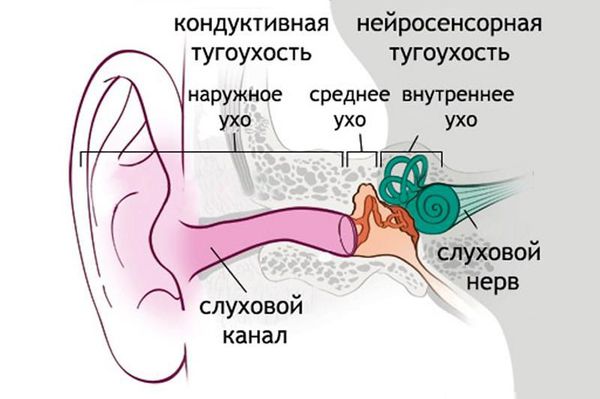 Кохлеарный неврит: причины, симптомы, диагностика и лечение