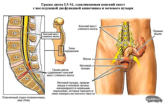 Грыжа диска с5 с6 шейного отдела позвоночника при остеохондрозе