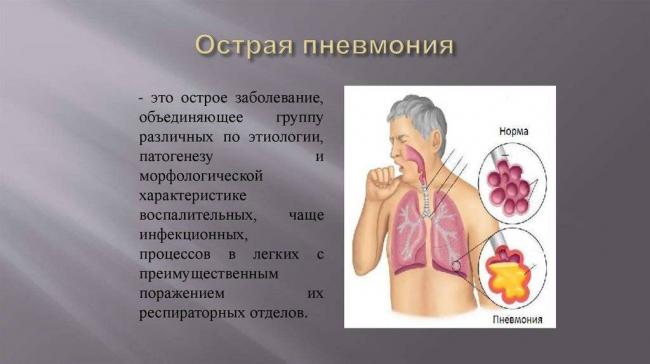 Пневмония