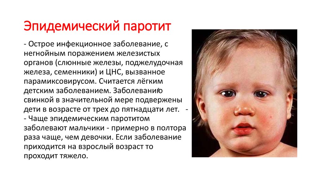 Эпидемический паротит (свинка): вирус, симптомы у детей и взрослых, лечение. последствия заболевания у мальчиков. фото
