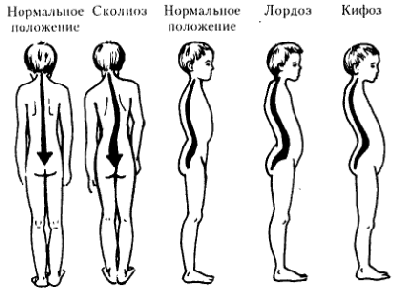 Что такое сколиоз у детей и как его вылечить?