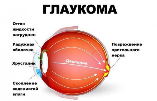 Что такое амавроз глаза: симптомы и лечение