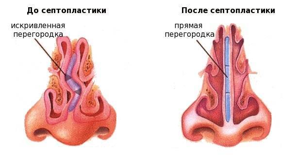 Лазерная септопластика: недостатки, противопоказания, фото