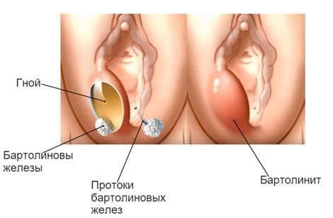 Бартолиновая железа – важные функции органа и самые частые заболевания