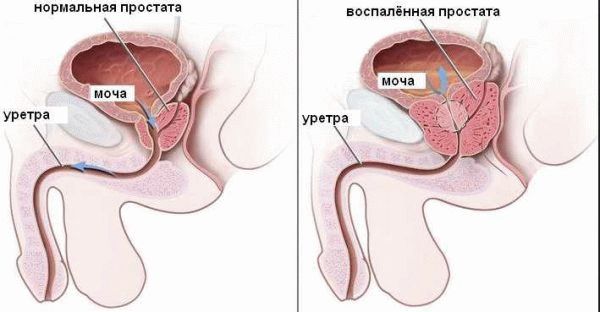 Простакор