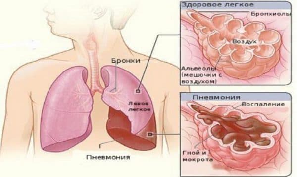 Правосторонняя верхнедолевая пневмония: особенности проявления заболевания