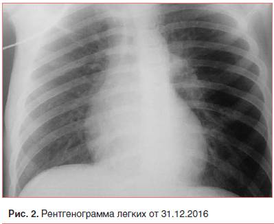 Симптомы и методы лечения прикорневой пневмонии у детей