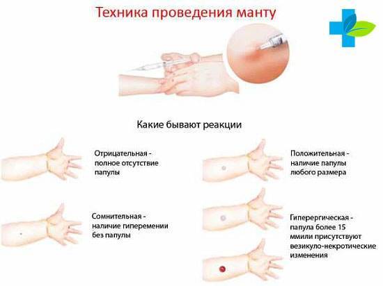 Реакция манту положительная: причины, объяснения, фото