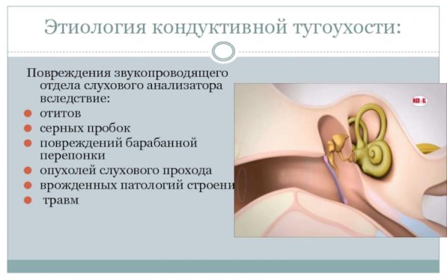 Нейросенсорная тугоухость (неврит слухового нерва): симптомы, лечение, диагностика, прогноз
