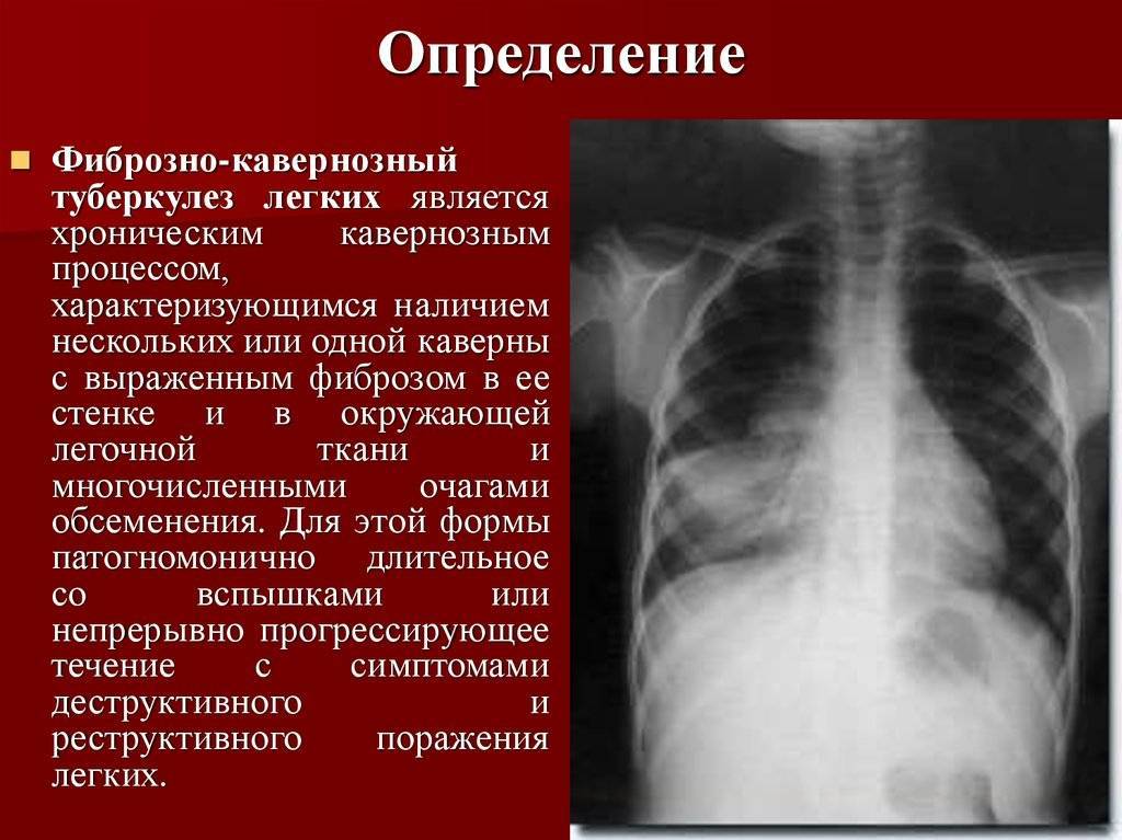 Фиброзно-кавернозный туберкулез - симптомы болезни, профилактика и лечение фиброзно-кавернозного туберкулеза, причины заболевания и его диагностика на eurolab