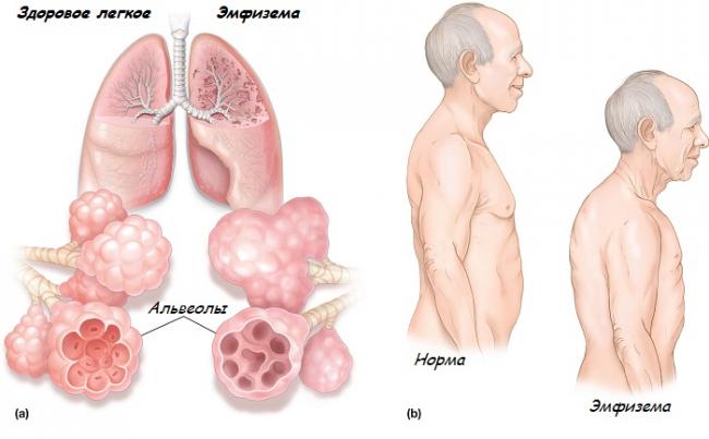 Классификация бронхиальной астмы