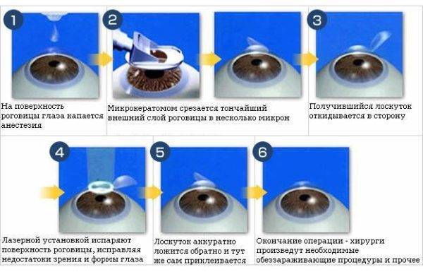 Перечень ограничений после лазерной коррекции зрения