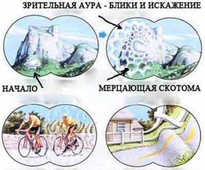 Глазная мигрень или мерцательная скотома: в чем причина и как лечить