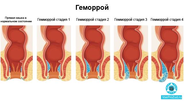 Зуд в заднем проходе, причины вызывающие зуд и как от него избавиться
