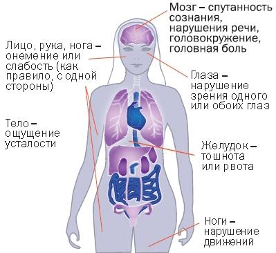 Острые нарушения мозгового кровообращения-виды, симптомы, лечение