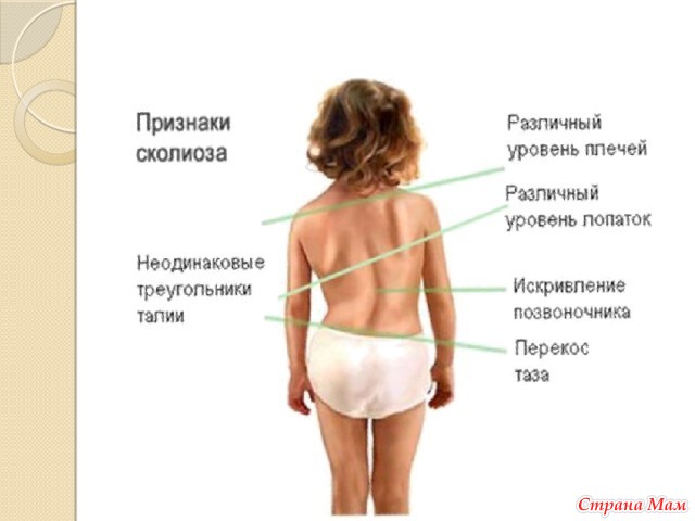 Сколиоз: диагностика, лечение, профилактика