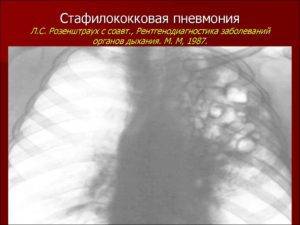 Стафилококковая пневмония у взрослых: симптомы, лечение и причины