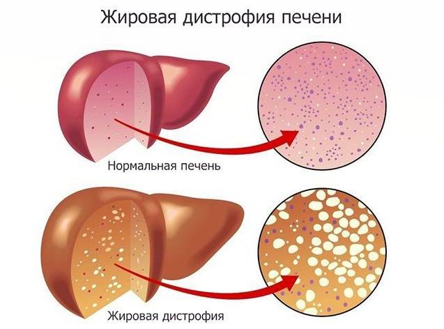 Жировой гепатоз печени: диета, лечение, меню на неделю