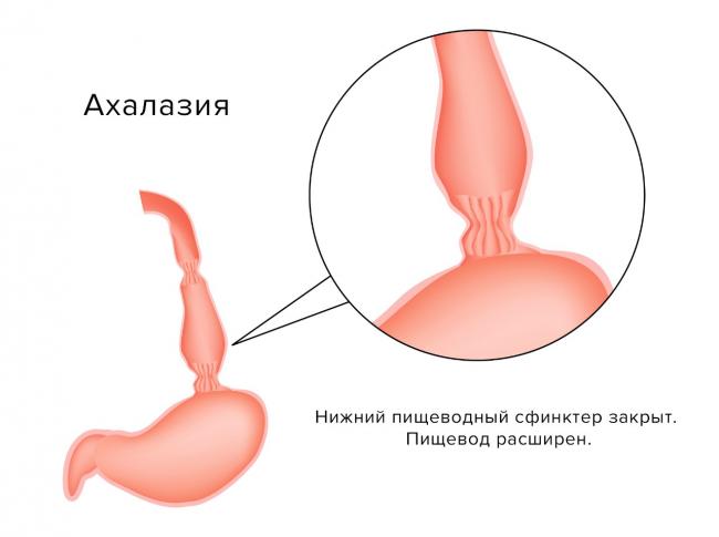 Ахалазия кардии пищевода — лечение и возможные осложнения болезни