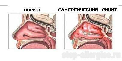 Consilium medicum №09 2001 - приложение - клинические рекомендации по диагностике и лечению аллергического ринита