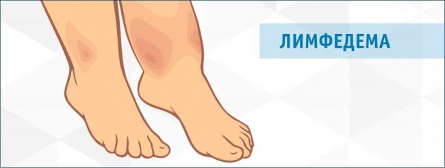 Лимфостаз – причины, симптомы, диагностика и лечение