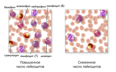 Диета при миеломной болезни