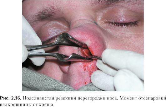 Хроническое заболевание полости носа характеризующееся атрофией