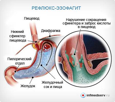 Диета при рефлюксе эзофагите меню на неделю