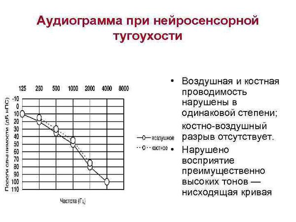 Нейросенсорная (сенсоневральная) тугоухость