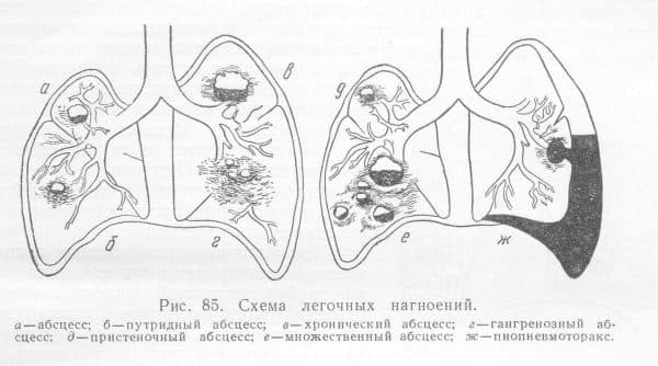 Острая пневмония