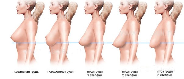 Обвисшая грудь: все о птозе молочных желез
