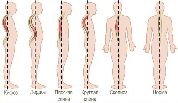 Сколиоз у детей – что влияет на его появление