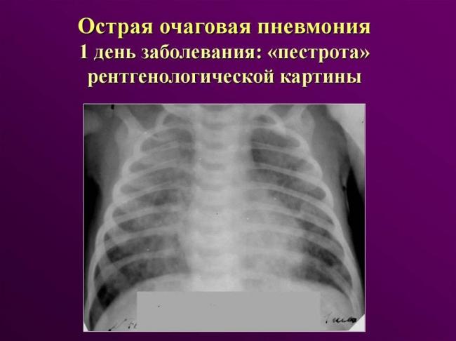 Этиология, причины, симптомы и последствия острой пневмонии