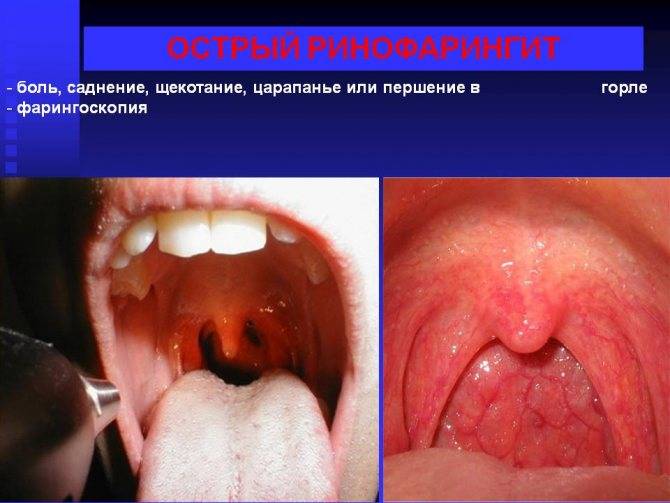 Ринит фарингит ларингит бронхит трахеит