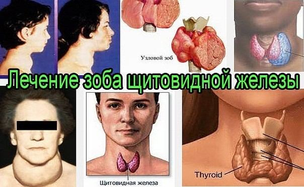 Зоб щитовидной железы (эндемический, узловой, диффузный, коллоидный, токсический) – симптомы, причины, лечение
