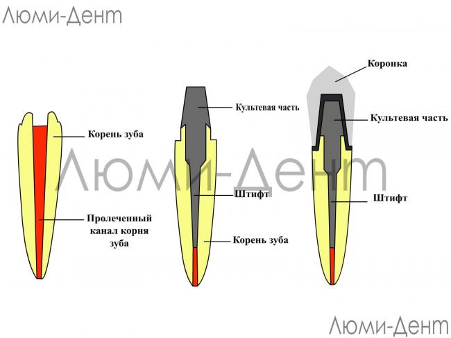 Восстановление зубов — можно ли восстановить зуб, обзор цен
