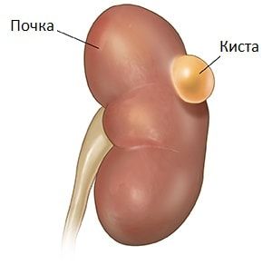 Киста почек у женщин - сложная проблема, с которой нужно бороться