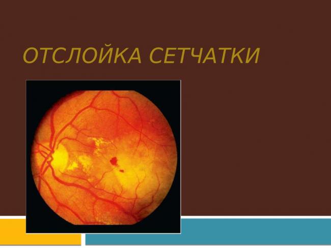Отслоение сетчатки