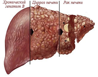 Причины и современное лечение хронического гепатита