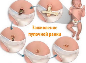 Мокнущий пупок у новорожденных: лечение и профилактика омфалита