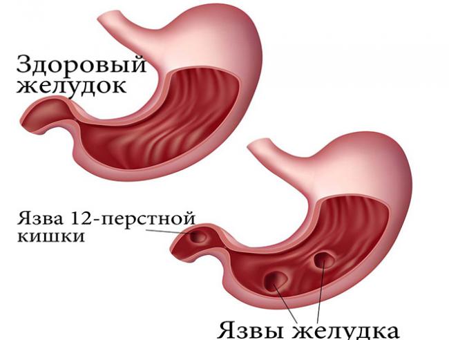 Ахалазия кардии и кардиоспазм