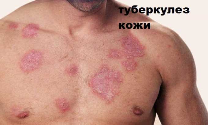 Полькортолон тс