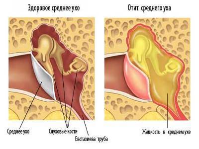 Антибиотик при отите ребенку