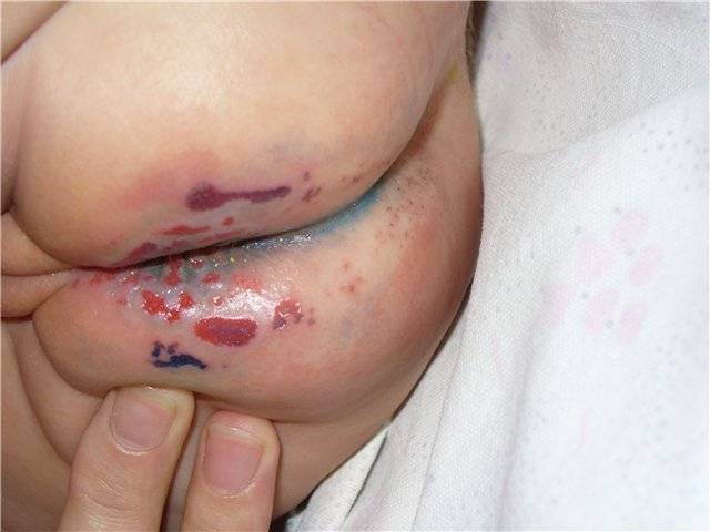 Сыпь на попе у ребенка 6 лет. появились высыпания от аллергии на попе у ребенка. лечение аллергической сыпи на попе у ребенка