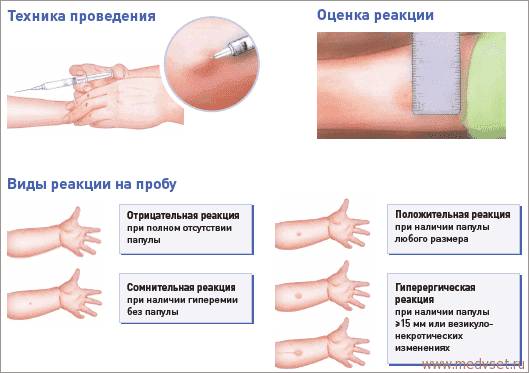 Туберкулез: пути передачи, симптомы, профилактика