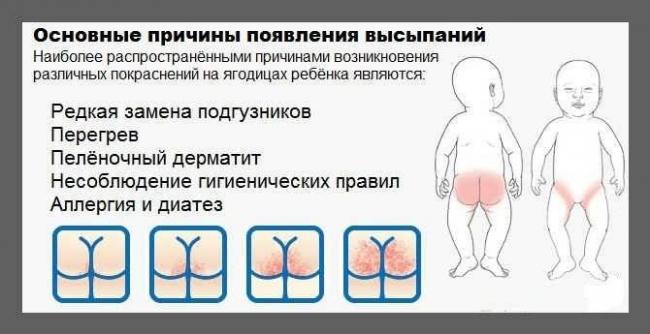 Сыпь на попе у ребенка 6 лет. появились высыпания от аллергии на попе у ребенка. лечение аллергической сыпи на попе у ребенка