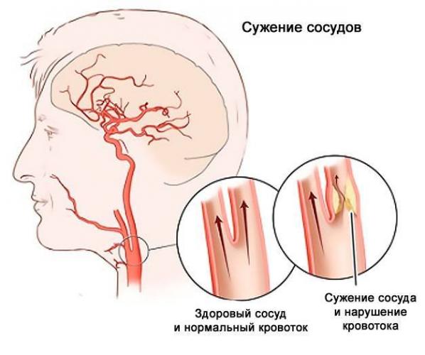 Стеноз сосудов в шейном отделе позвоночника