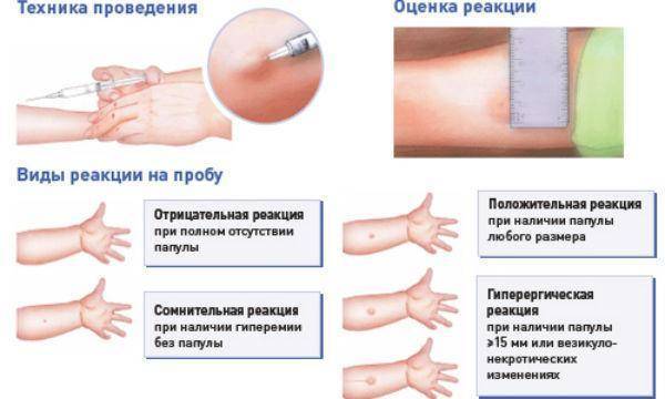 Что делать, если реакция манту положительная?